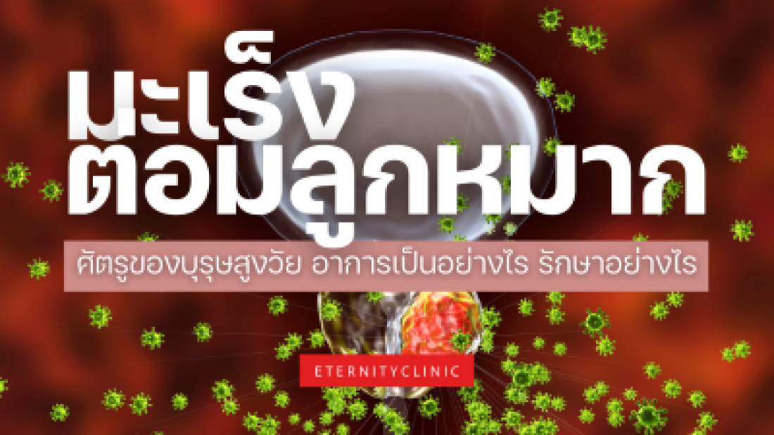 มะเร็งต่อมลูกหมาก ศัตรูของบุรุษสูงวัย อาการเป็นอย่างไร รักษาอย่างไร